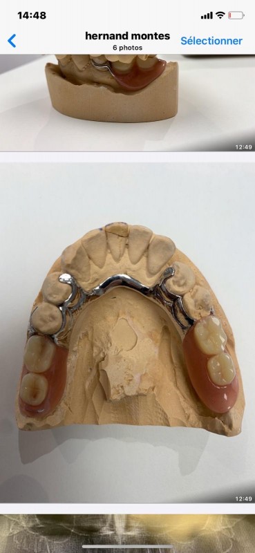 Fabrication de prothèses dentaires amovibles définitives a châssis métallique